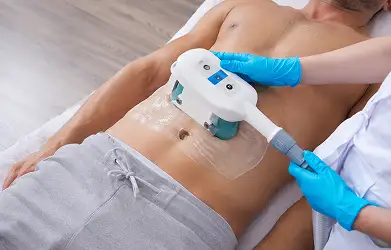 CoolSculpting