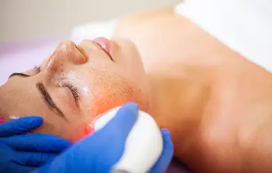 Laser Skin Resurfacing