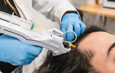  PRP Treatments