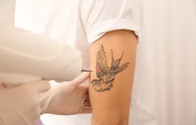 Tattoo Removal